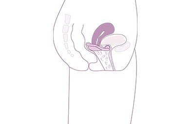 diaphragme contraceptif et spermatozoides