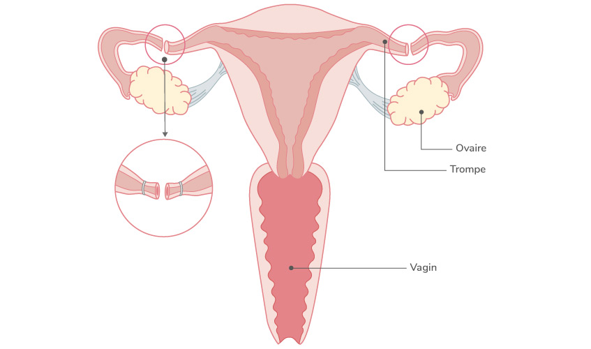 Schéma contraception - Ligature des trompes 