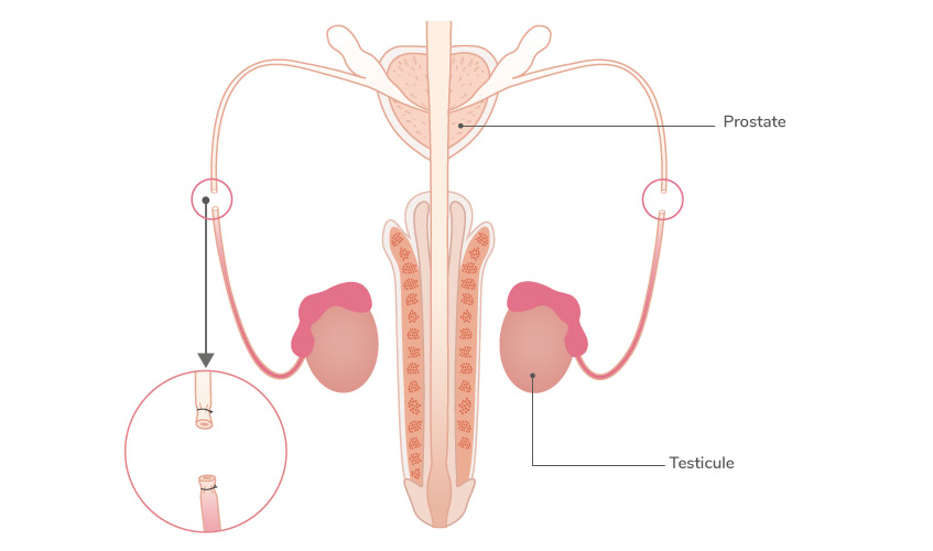 Schéma contraception - vasectomie
