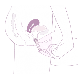 Insertion du diaphragme caya
