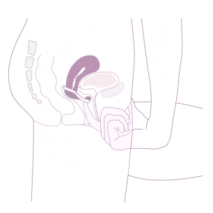 retrait du diaphragme caya