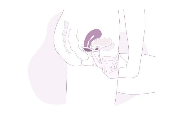 Etape 4 de la mise en place du diaphragme