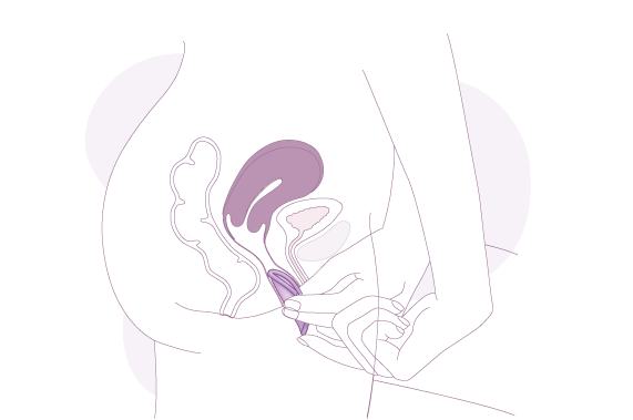 Etape 3 de la mise en place du diaphragme
