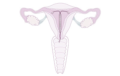 moyen de contraception hormonal